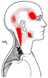Headaches & Pain in the Neck